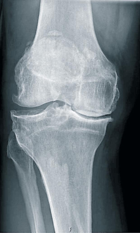 Knie met artrose 619x1024